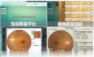眼底影像慢病智能筛查平台